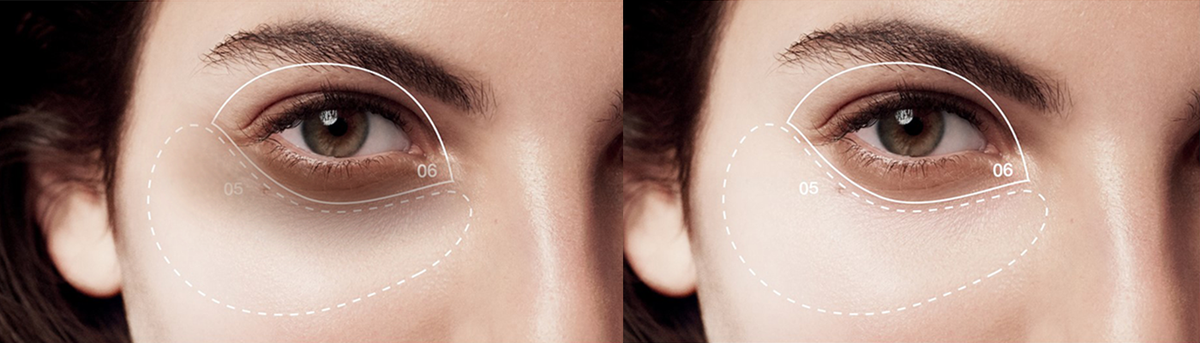 Get Rid Of Eye Bags Without Surgery