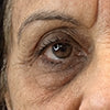 Eye Puffiness