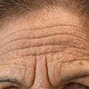 Forehead Wrinkles