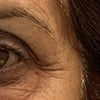 Wrinkles Around Eyes
